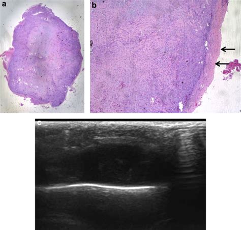 Nodular Fasciitis: Sonographic–Pathologic Correlation - Ultrasound in ...