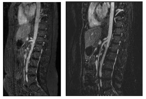 Median Arcuate Ligament Syndrome: Diagnosis and Treatment