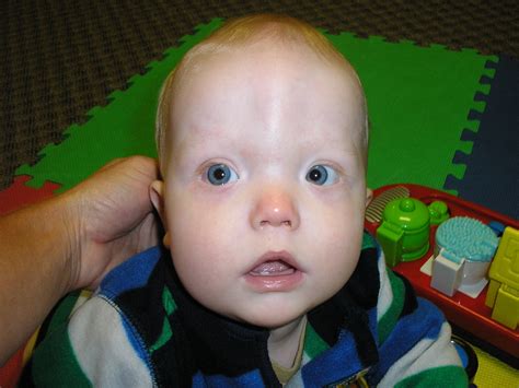 The Truth About Tummy Time: Plagiocephaly and Craniosynostosis