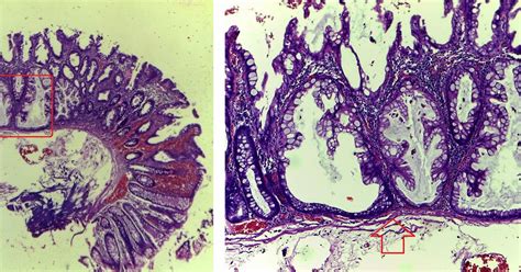 GASTROINTESTINAL AND LIVER HISTOLOGY PATHOLOGY ATLAS: SESSILE SERRATED POLYP (AKA SESSILE ...