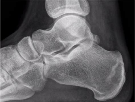 Treating Calcaneal Stress Fractures in Athletes | Podiatry Today