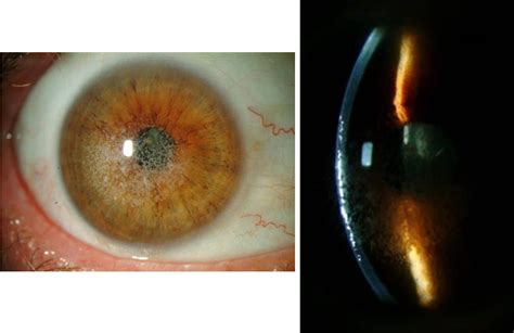 Post-LASIK Granular Corneal Dystrophy