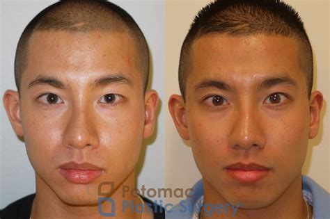 Upper Blepharoplasty on the left eye to give symmetry to the eyelids of ...