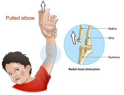 What Is A Dislocated Elbow Called at Randy Perry blog