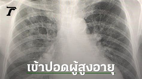 Outbreak of Human Metapneumovirus (hMPV) in Thailand: Case Study and ...