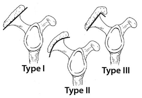 Understanding Acromioplasty - Academy of Clinical Massage