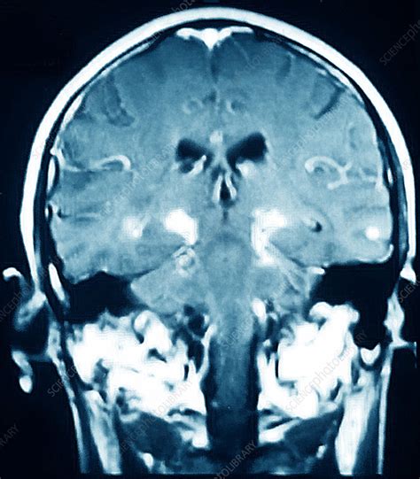 Parkinson's Disease, MRI - Stock Image - C017/0059 - Science Photo Library