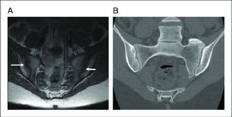 21-year-old female with dedicated Sacroiliac joint MRI and CT. (A) MRI ...