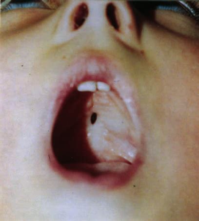 ( a ) Diagram of the two-flap palatoplasty technique. ( b ) Diagram of... | Download Scientific ...