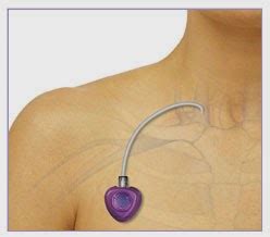 How to Place a Chest Port - Radiology Imaging