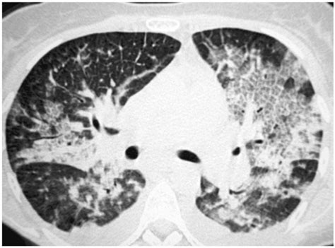 28-year-old man with acute pulmonary edema. High-resolution CT scan at... | Download Scientific ...