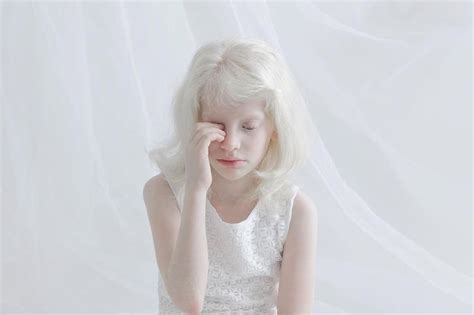 Photographers Capture the Unique Beauty of Albino People, and People Can’t Stop Loving Them ...