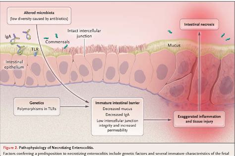 [PDF] Necrotizing enterocolitis. | Semantic Scholar