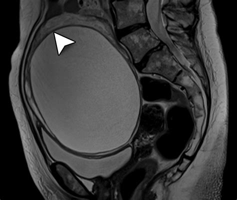 Adnexal Torsion: Review of Radiologic Appearances | RadioGraphics