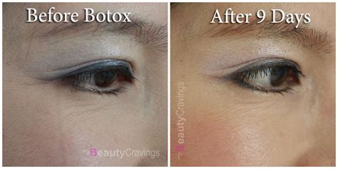 Review: Erase Under-eye Wrinkles with Botox » myBeautyCravings