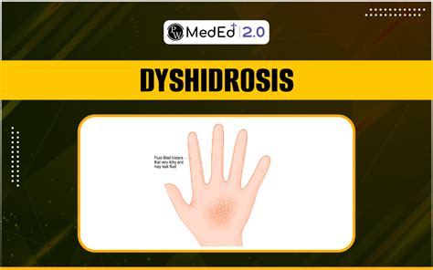 Dyshidrosis Causes, Symptoms, Risk Factors, Diagnosis, And Treatment