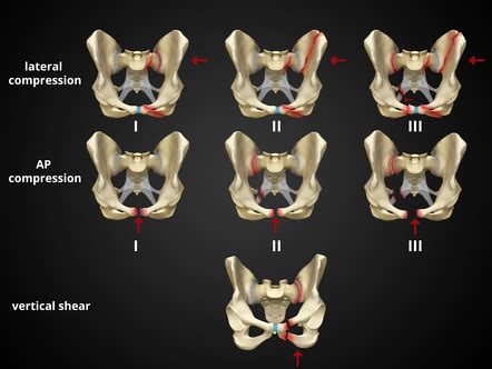 Young and Burgess classification of pelvic ring fractures | Radiology Reference Article ...