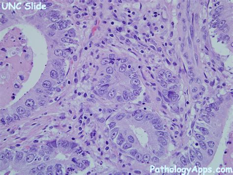 adenocarcinoma stomach histology