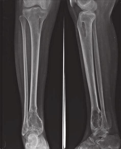 Right leg radiography showing bone changes in the distal tibia ...