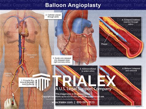 Balloon Angioplasty - Trial Exhibits Inc.