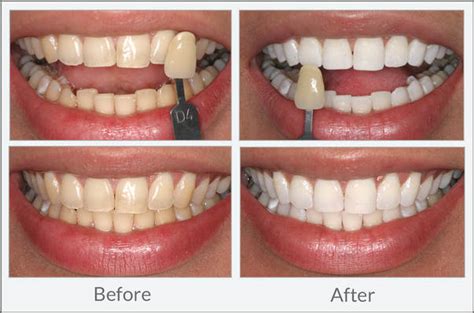 Teeth Whitening - DENTAL EXCELLENCE