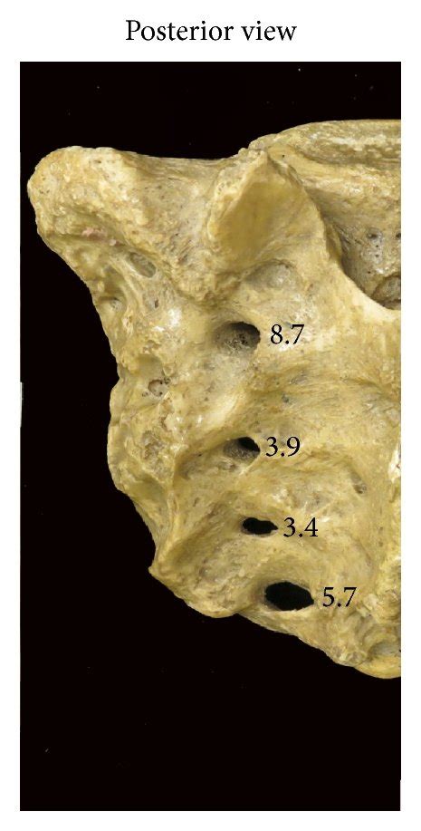 Variation in the shape and size of the posterior sacral foramina. (a)... | Download Scientific ...