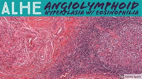 ALHE (Angiolymphoid Hyperplasia with Eosinophilia): 5-Minute Pathology Pearls - YouTube