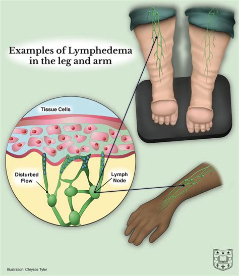 Ask the Doctors: Lymphedema Symptoms and Causes with Doctors Sacks and Anolik | Department of ...