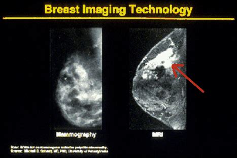 Understanding Breast Cancer and Mammograms | Negative and Positive Her2 Breast Cancer