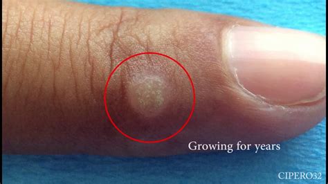 Plantar Wart Removal Cryotherapy | Bruin Blog