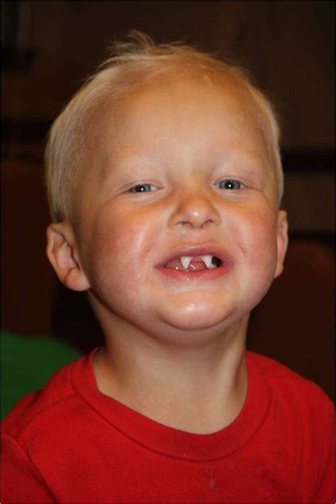 Ectodermal dysplasia: Types, Causes, Symptoms and Treatments