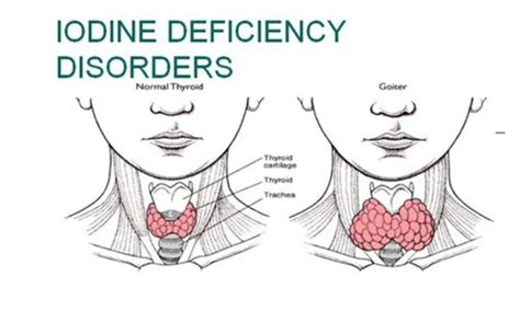 How does iodine deficiency impact the thyroid? - FITPAA