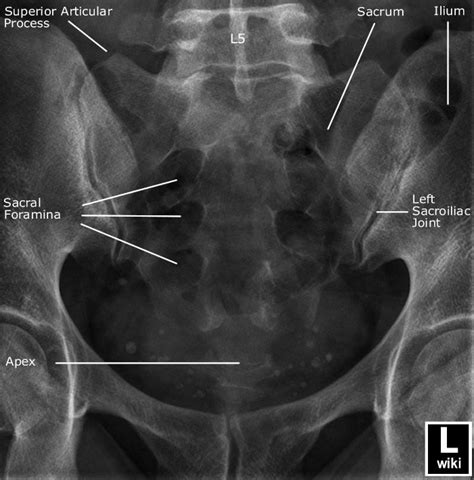 Sacrum Radiographic Anatomy - wikiRadiography | Diagnostic imaging ...