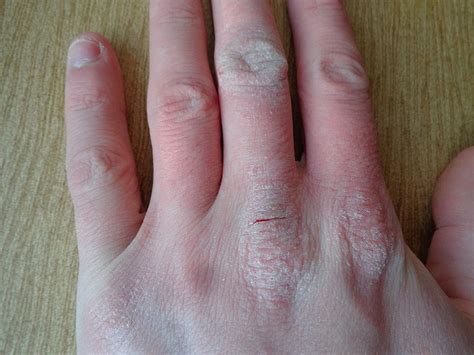 Experts Provide Update on New Drugs for Eczema | Immunology