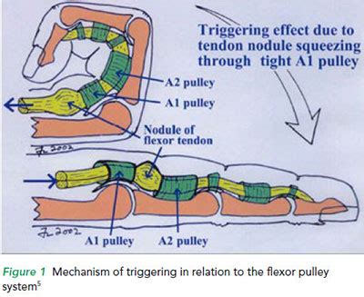 Mechanism of triggering in relation to the flexor pulley system - SGH