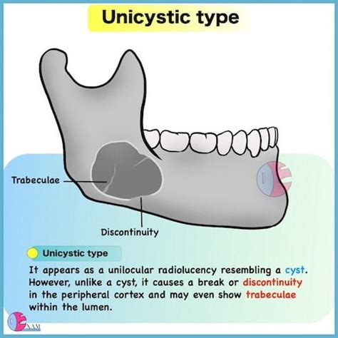 Ameloblastoma Radiology: Dental Radiology Notes