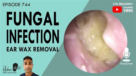 744 - Fungal Ear Infection Ear Wax Removal - YouTube