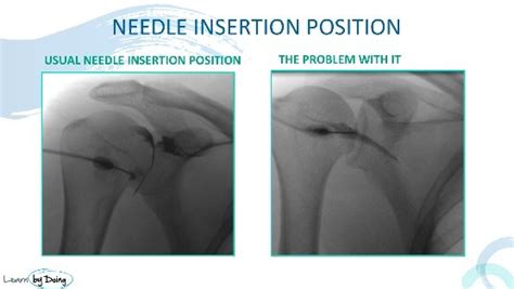 MRA SHOULDER ARTHROGRAMS: HOW TO DO IT - Radedasia