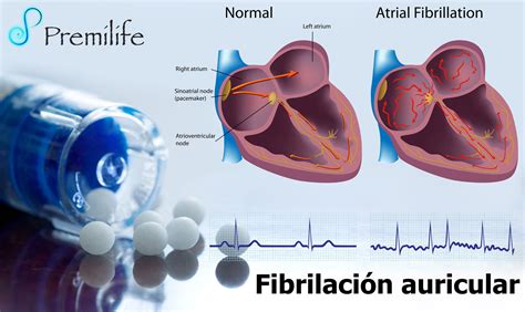 estoy sediento Apretar Amplificador fibrilacion auricular homeopatia Soplar Cívico diluido