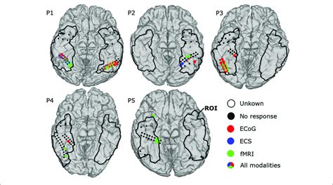 | Mapping results for comparison among three modalities: ECoG, ECS, and ...