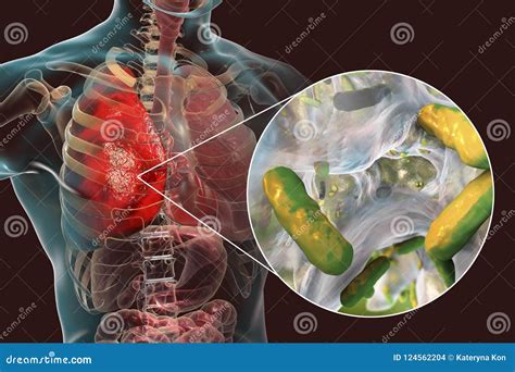 Lung Infection Caused by Bacteria Pseudomonas Aeruginosa Stock ...