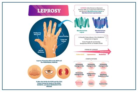 Leprosy: Types, Symptoms, Causes, Diagnosis & Treatment