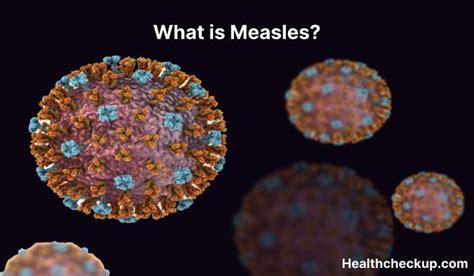 Measles - Symptoms, Diagnosis, Treatment, Prevention - Health CheckUp