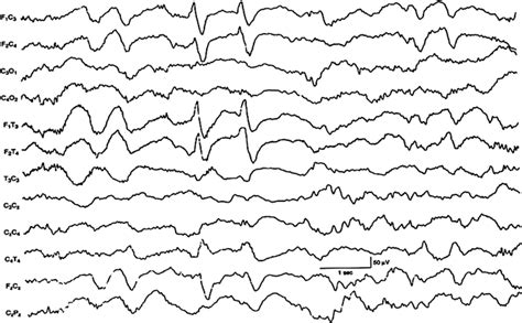 Neonatal EEG and Neonatal Seizures | Neupsy Key