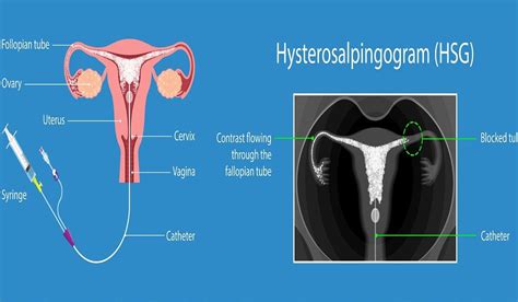 hysterosalpingogram - Little Angel IVF