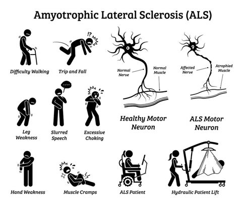 13 Early Warning Signs & Symptoms of ALS (Amyotrophic Lateral Sclerosis)