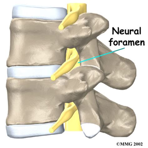 Neural Foramen - Neural Foraminal Narrowing