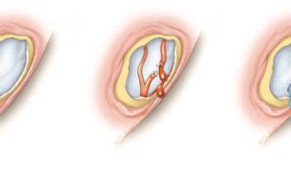 Complications of Mastoidectomy – Oto Surgery Atlas