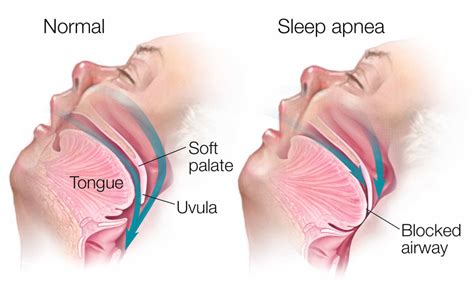 Sleep Apnea Solutions – Triangle Family Dentistry