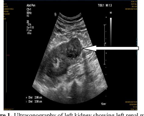 [PDF] Stauffer’s Syndrome: A Rare Case Report | Semantic Scholar